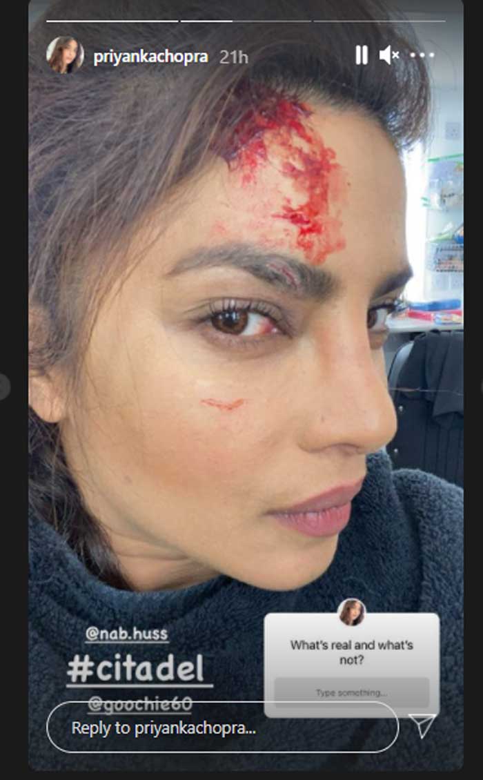 Citadel' Star Priyanka Chopra Jonas Reveals On-Set Injury