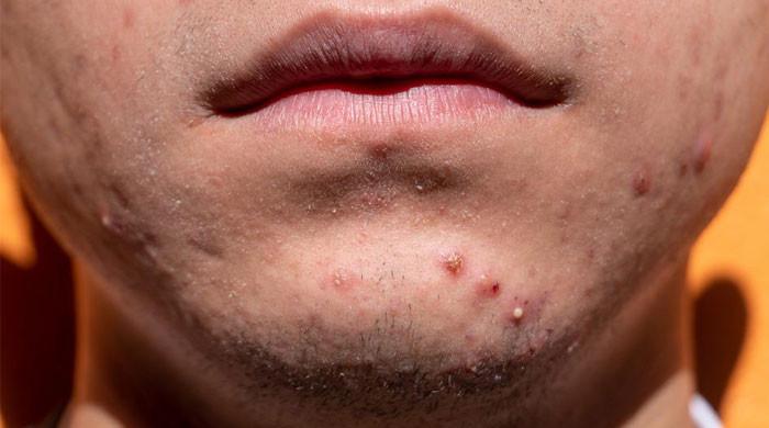 New acne treatment 'exciting', but Europe will have to wait