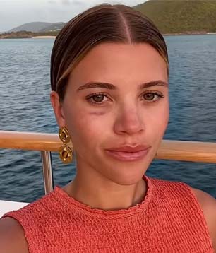 Sofia Richie gets black eye from wakeboarding accident