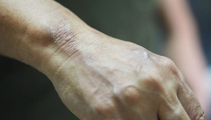 Leprosy is a bacterial disease that attacks the skin and nerves. cbsnews.com