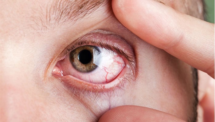 This representational image shows a dry-eye patient. — UVALasik/File