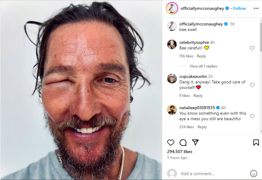 Mathew McConaughey shares shocking swollen eye picture