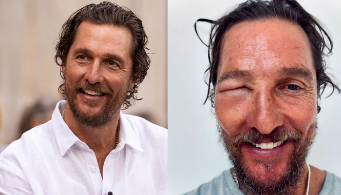 Mathew McConaughey shares shocking swollen eye picture