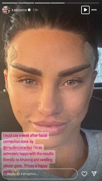 Katie Price finally happy with latest facelift results despite court issues