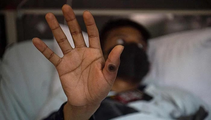 A patient shows his hand with a sore caused by an infection of the monkeypox virus, in the isolation area at the Arzobispo Loayza hospital, in Lima, Peru, August 16, 2022. — AFP