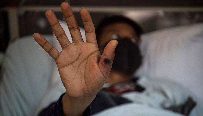 This file photo taken on August 16, 2022 shows a patient showing his hand with a sore caused by an infection of the monkeypox virus, in the isolation area for monkeypox patients at the Arzobispo Loayza hospital, in Lima, Peru. — AFP