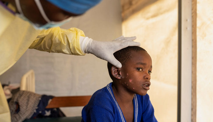 A doctor verifies the evolution of skin lesions on the ear of a child, suffering from Mpox at the treatment centre in Munigi, following Mpox cases in Nyiragongo territory near Goma, North Kivu province, Democratic Republic of the Congo July 19, 2024. — Reuters