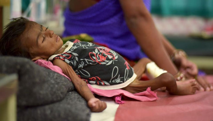 A representational image showing a child suffering from malnutrition. — Reuters/File