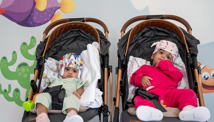 Pakistani conjoined twins, Mirha and Minal, separated after successful surgery by Turkish doctors at Bilkent City Hospital, Ankara. — Anadolu Agency