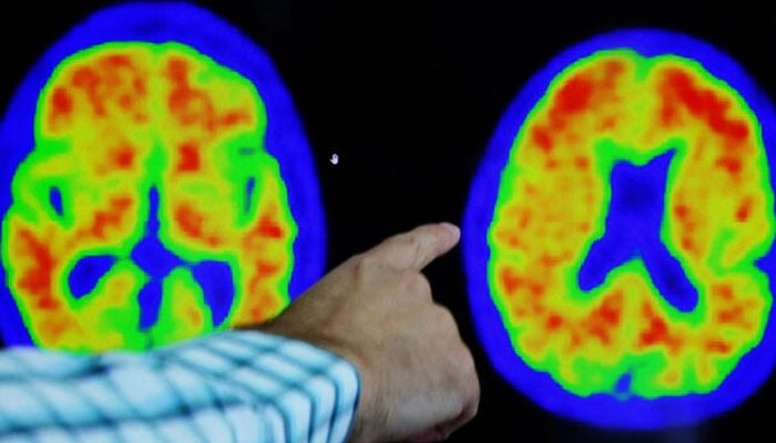 A doctor points out evidence of Alzheimers disease on PET scans at the Center for Alzheimer Research and Treatment (CART) at Brigham And Womens Hospital in Boston, Massachusetts, US, March 30, 2023. — Reuters