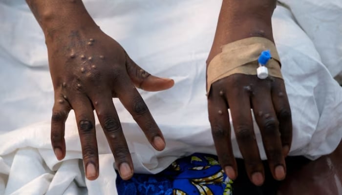 The hands of a patient with skin rashes caused by the mpox virus are pictured at the treatment center of Vijana Hospital in Kinshasa, Congo, on August 30, 2024. —Reuters