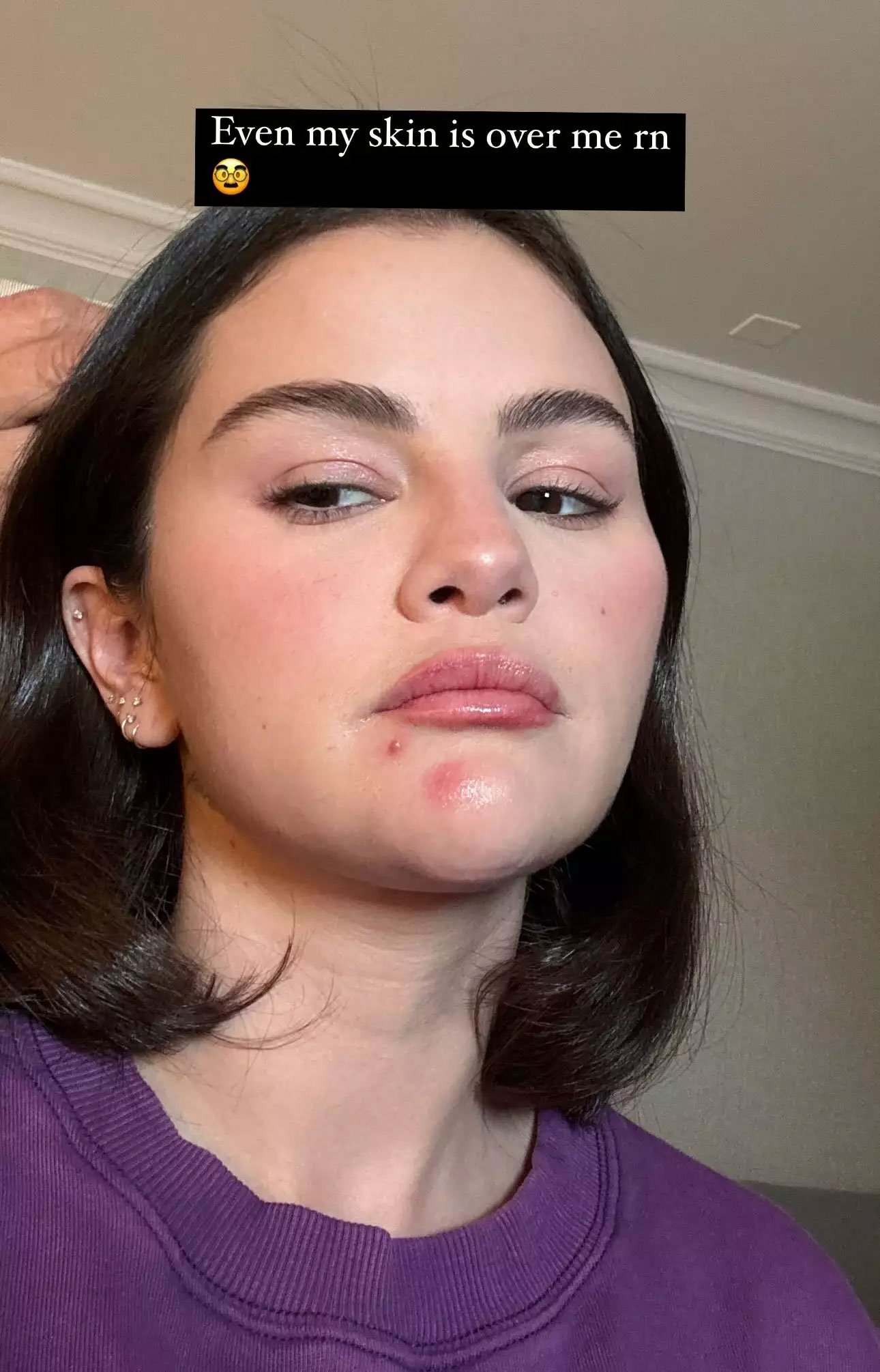 Selena Gomez goes unfiltered about skin troubles