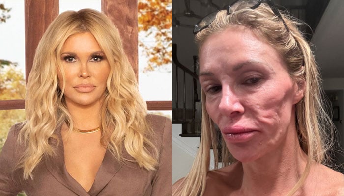 Brandi Glanville opens up about her shocking facial disfigurement