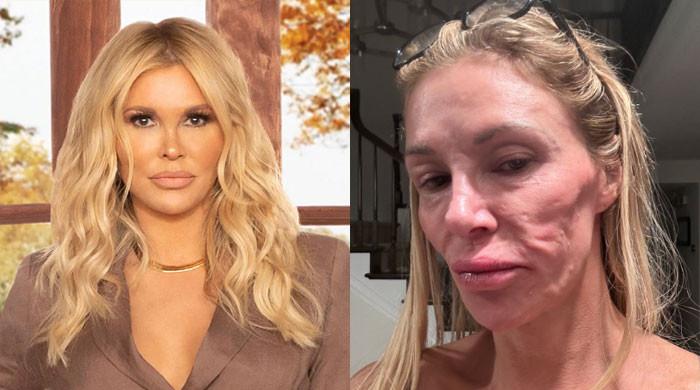 Brandi Glanville ‘desperately’ wants solution for facial disfigurement