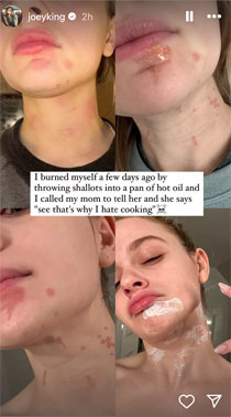 Joey King reveals painful mishap left her with unexpected burns