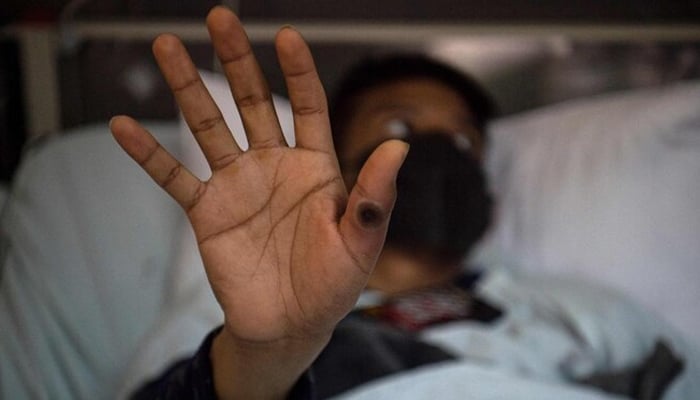 A patient is showing his hand with a sore caused by an infection of the monkeypox virus, in the isolation area for monkeypox patients at the Arzobispo Loayza hospital, in Lima, Peru on August 16, 2022. — AFP